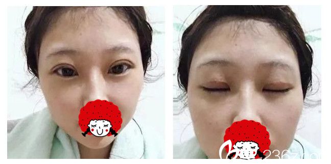 术后半个月双眼皮+祛斑恢复