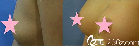 方暖硕自体丰胸真实案例 方暖硕自体丰胸真实案例