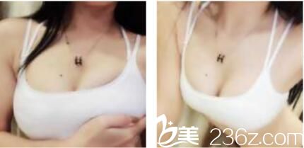 韩国快乐隆胸技术好不好？三个月前找钟泰元做假体隆胸现在手感特别的柔软