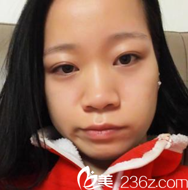 来广州曙光整形医院整形术前 来广州曙光整形医院整形术前