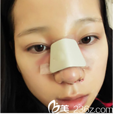 广州曙光整形医院范思军隆鼻术后7天 广州曙光整形医院范思军隆鼻术后7天