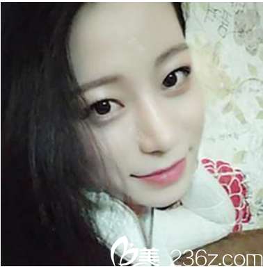 广州曙光整形医院范思军鼻综合隆鼻案例术后三个月 广州曙光整形医院范思军鼻综合隆鼻案例术后三个月