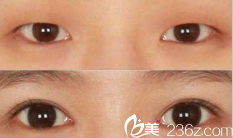 衡阳雅美医疗美容医院双眼皮案例效果图