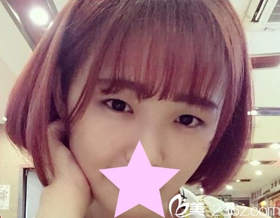 韩国TheOne整形医院双眼皮手术前 韩国TheOne整形医院双眼皮手术前