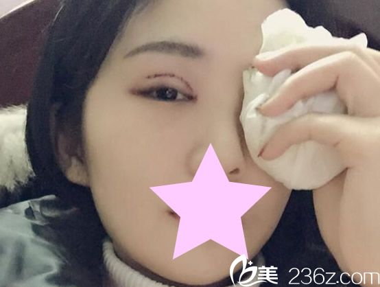双眼皮的恢复过程,术后第二天 双眼皮的恢复过程,术后第二天