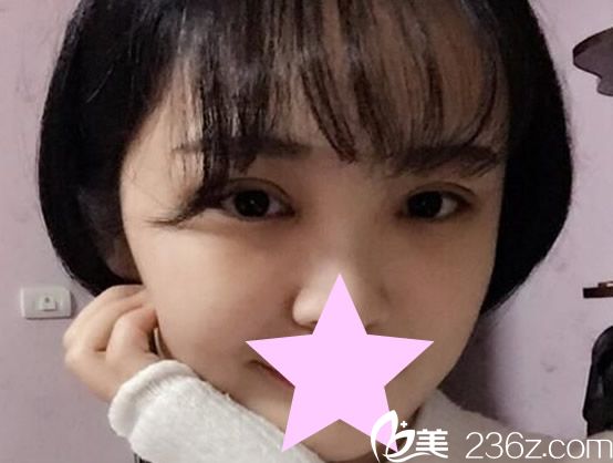 全切双眼皮7-15天恢复图片 全切双眼皮7-15天恢复图片