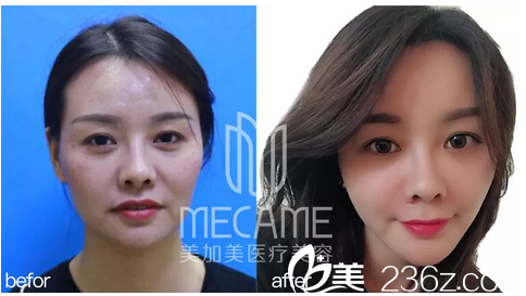 深圳美加美陈群自体脂肪面部填充案例前后对比图 深圳美加美陈群自体脂肪面部填充案例前后对比图