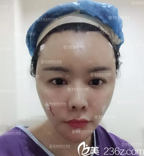 找深圳美加美陈群做完面部脂肪填充术后即刻效果图 找深圳美加美陈群做完面部脂肪填充术后即刻效果图