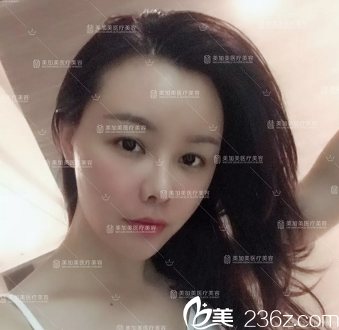 去深圳美加美做完自体脂肪填充两周恢复效果 去深圳美加美做完自体脂肪填充两周恢复效果