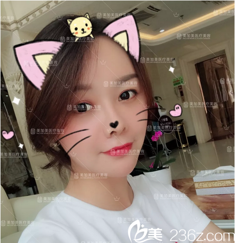 深圳美加美陈群自体脂肪全脸填充术后半个月自拍 深圳美加美陈群自体脂肪全脸填充术后半个月自拍