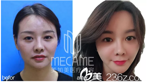 深圳美加美整形医院陈群自体脂肪填充对比案例 深圳美加美整形医院陈群自体脂肪填充对比案例