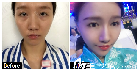 深圳美加美整形医院陈群隆鼻案例前后对比 深圳美加美整形医院陈群隆鼻案例前后对比