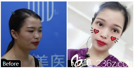 深圳美加美整形医院陈群双眼皮案例 深圳美加美整形医院陈群双眼皮案例