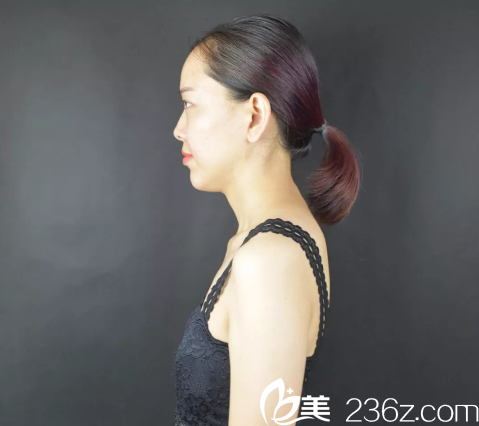 深圳雅涵整形医院高山隆胸术前 深圳雅涵整形医院高山隆胸术前