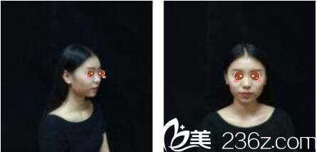 韩国乐世里LUXELL整形医院金弘承面部埋线提升真人案例术前照 韩国乐世里LUXELL整形医院金弘承面部埋线提升真人案例术前照