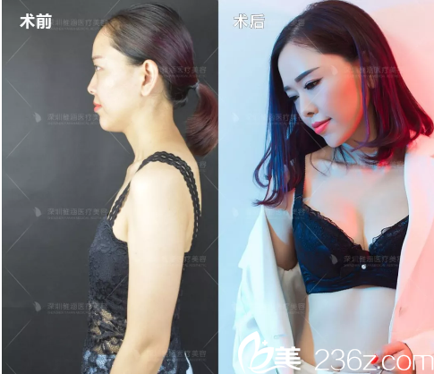 深圳雅涵整形医院高山隆胸案例对比图 深圳雅涵整形医院高山隆胸案例对比图