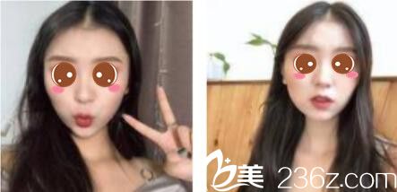 韩国乐世里LUXELL整形医院金弘承面部埋线提升真人案例术后十五天 韩国乐世里LUXELL整形医院金弘承面部埋线提升真人案例术后十五天