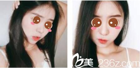 韩国乐世里LUXELL整形医院金弘承面部埋线提升真人案例术后一个月 韩国乐世里LUXELL整形医院金弘承面部埋线提升真人案例术后一个月