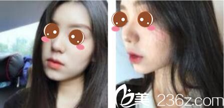 韩国乐世里LUXELL整形医院金弘承面部埋线提升真人案例术后三个月 韩国乐世里LUXELL整形医院金弘承面部埋线提升真人案例术后三个月