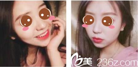 半年前去韩国乐世里找金弘承做了面部线雕提升，术后效果特别自然感觉较少年轻五岁