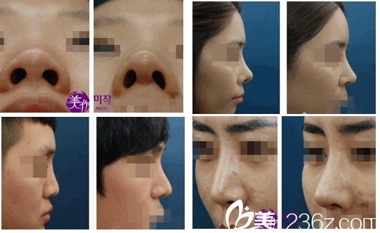 韩国美作整形医院安恩模院长鼻整形手术案例分享