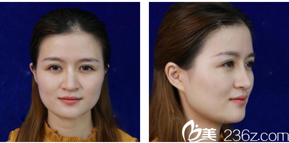 广州韩妃整形医院陈坦线雕埋线提升术前 广州韩妃整形医院陈坦线雕埋线提升术前