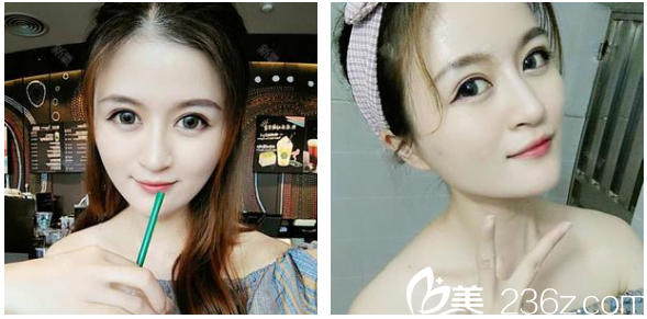 广州韩妃陈坦做的线雕案例术后一个月 广州韩妃陈坦做的线雕案例术后一个月