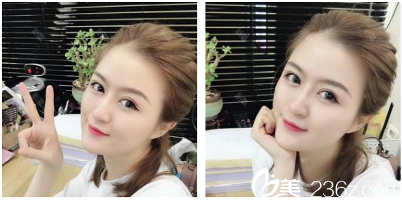 广州韩妃陈坦线雕+玻尿酸填充+瘦脸案例 广州韩妃陈坦线雕+玻尿酸填充+瘦脸案例