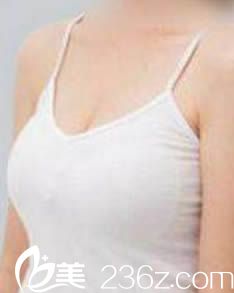 韩国一美知整形外科隆胸效果图