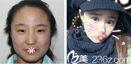 韩国GIO整形外科车知勳做双眼皮效果好不好