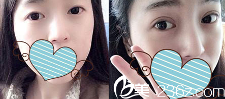 太原时光整形双眼皮失败修复案例效果图