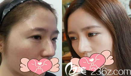 太原时光隆鼻术前术后效果对比图