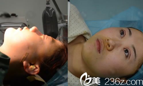 杭州瑞丽王俞明做双眼皮隆鼻过程