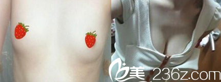 太原时光整形隆胸前后效果对比图