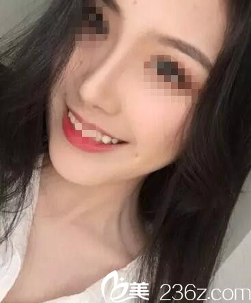想甩掉塌鼻梁吗？看我在济源萍做假体隆鼻+鼻翼缩小术后效果