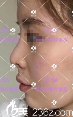 长春艾尔莎鼻综合手术前 长春艾尔莎鼻综合手术前