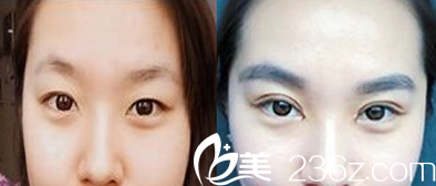 聊城韩美双眼皮案例效果对比图