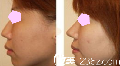 聊城韩美整形隆鼻案例效果图