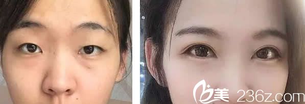 兰州韩美双眼皮+开眼角效果案例 兰州韩美双眼皮+开眼角效果案例
