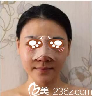在郑州禾丽做鼻综合手术当天