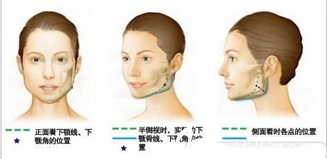 李斗荣美笑整形外科下颌角磨骨 李斗荣美笑整形外科下颌角磨骨