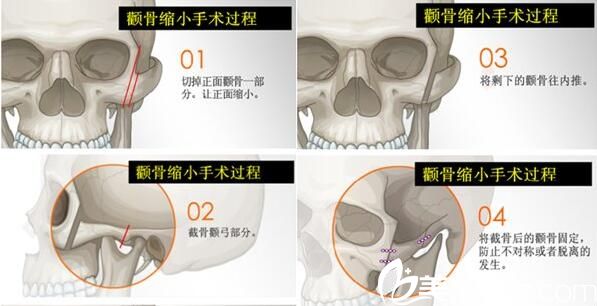 韩国李斗荣美笑整形外科李斗荣颧骨整形