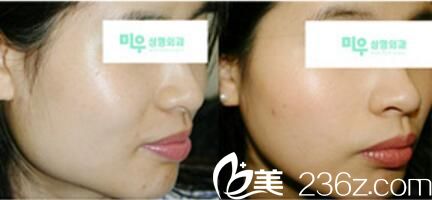 下颌角真人前后对比照