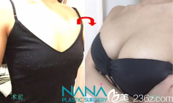 黄铜渊院长复合隆胸前后效果案例 黄铜渊院长复合隆胸前后效果案例