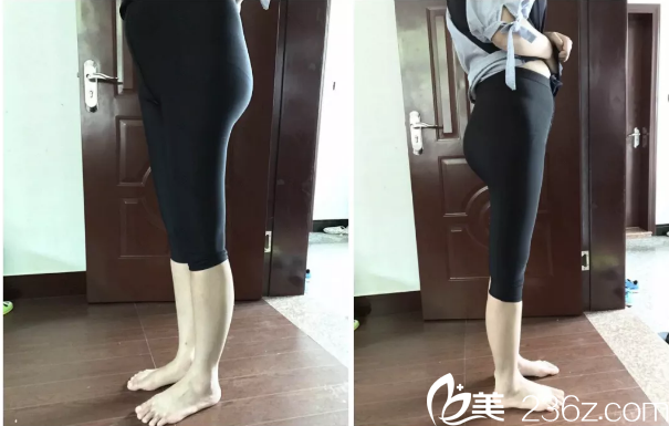 在韩国THE整形医院做腿部吸脂第8天效果 在韩国THE整形医院做腿部吸脂第8天效果