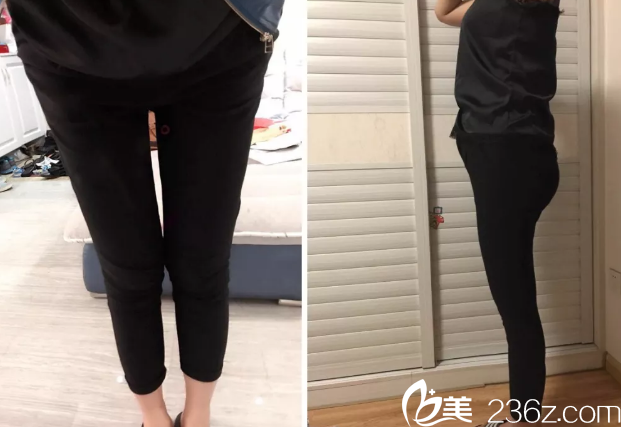 韩国THE整形外科医院金洙喆腿部吸脂第13天效果 韩国THE整形外科医院金洙喆腿部吸脂第13天效果