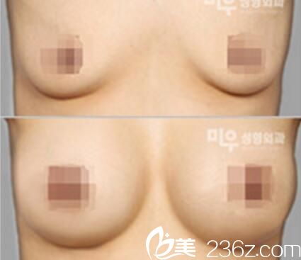 假体丰胸前后对比 假体丰胸前后对比