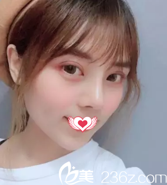 趁着暑期有整形优惠找邢台博爱高玉伟做了肋骨隆鼻+耳软骨垫鼻尖 恢复22天后我的小翘鼻宛若天生