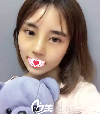 鼻综合7天后鼻子慢慢消肿 鼻综合7天后鼻子慢慢消肿