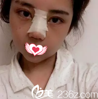 刚做完鼻综合鼻子肿胀 刚做完鼻综合鼻子肿胀